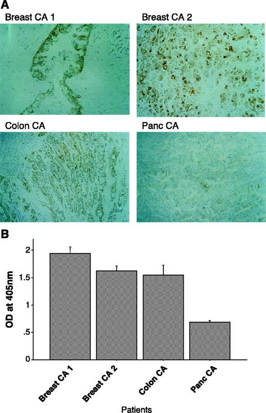 Fig. 5. Correlation of the level of cyclin B1 expression in the tumor and the level of serum antibody reactivity in ELISA. A, sections of metastatic lesions from two breast cancer patients and one colon cancer patient and the primary tumor from a pancreatic cancer patient were stained with anti-cyclin B1 antibody for the presence of cyclin B1 protein. Magnification 100×. B, sera from the same four patients were tested in ELISA for the presence of anti-cyclin B1 antibody. Absorbance at 405 nm. Column, mean value of triplicate wells; bars, ±SE.