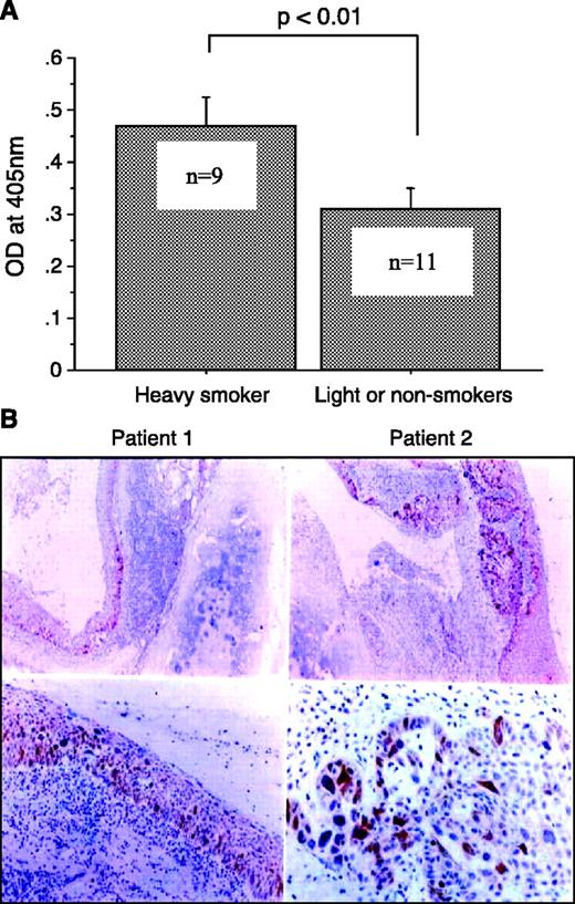 Fig. 6. Anti-cyclin B1 antibody in patients with benign and premalignant lung disease and cyclin B1 overexpression in premalignant lesions. A, sera from 20 patients with benign lung disease were tested by ELISA. Patients were divided into two groups by smoking history (heavy smoker group, ≥40 pack-years; light or nonsmoker group, <40 pack-years). B, staining for cyclin B1 overexpression in bronchial metaplasia (patient 1) and dysplasia (patient 2). Top, at 40× original magnification; bottom, at 100× original magnification.