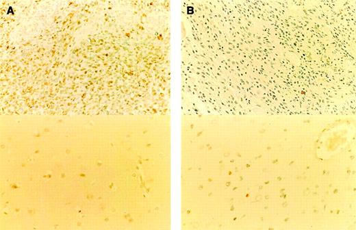 Fig. 2. Immunohistochemical staining of hMLH1 in malignant astrocytomas. A, an hMLH1-unmethylated case. The neoplastic cells (top) and corresponding normal cells (bottom) reveal nuclear expression of hMLH1 in a heterogeneous pattern; B, an hMLH1-methylated case. The neoplastic cells display a complete lack of hMLH1 expression (top), whereas corresponding normal cells show nuclear expression of hMLH1 (bottom). Magnification, ×80 (top); ×100 (bottom).