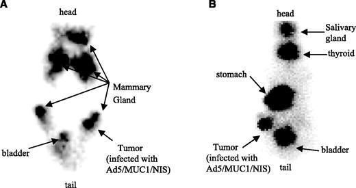 Fig. 4. In vivo T47D tumor imaging of two mice using a γ camera after administration of 0.5 mCi 123I. Three days before iodide administration, mice were given intratumoral injections of Ad/MUC1/NIS or control virus. A, image of a mouse with high serum estradiol levels as a result of an implant to support tumor growth; it revealed a pattern of uptake correlating with the location of the multiple mammary glands in the mice as well as at the site of the MUC1/NIS-infected tumor. B, image of a second mouse 10 days after removal of the estradiol pellet; this revealed an image showing iodide uptake in the thyroid and stomach, which both express NIS, and in the bladder, where iodide was being cleared in the urine. There was also a clear image of the tumor that had been infected with Ad/MUC1/NIS on the left flank, whereas the tumor infected with control virus on the right flank did not concentrate iodide. There was no detectable uptake of iodide in the mammary glands of this animal.