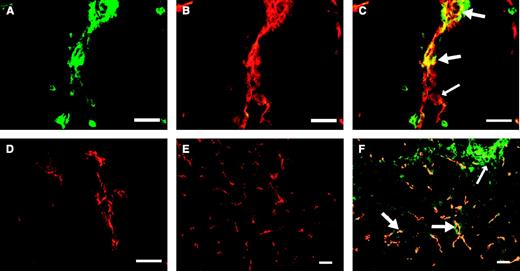 Fig. 3. Localization of 3G4 to tumor vessels and necrotic tumor cells after injection into mice bearing orthotopic MBA-MB-435 human breast tumors. SCID mice bearing 0.5 cm diameter MDA-MB-435 tumors in their mammary fat pads were injected i.p. with 100 μg 3G4 or control mouse IgG3 (BBG3). Six hours later, the mice were exsanguinated and their tumors were removed. A-C, typical vessel in a frozen section of tumor at high magnification. The sections were stained with biotinylated goat anti-mouse IgG followed by FITC-streptavidin (green) to detect localized 3G4 (A), and with rat anti-mouse CD31 followed by Cy3 goat anti-rat IgG (red) to detect vascular endothelium (B). C, merged image of 3G4 localized to CD31-positive endothelium (thick arrows). Some regions of the vessel are CD31-positive but are not stained by 3G4 (thin arrow). D, typical vessel in the tumor of a control mouse injected with BBG3. No binding of BBG3 is seen. E, low-magnification view of a merged image of tumor from a control mouse injected with BBG3. No localization of BBG3 to vascular endothelium is seen. Tumor cells in necrotic regions are also unstained, as in the top right of the panel where CD31-positive vessels are absent. F, low-magnification view of a merged image of a tumor from a mouse injected with 3G4. Localization of 3G4 to vessels (thick arrows) and to necrotic tumor cells (thin arrow) is seen. Scale bar, 50 μm.