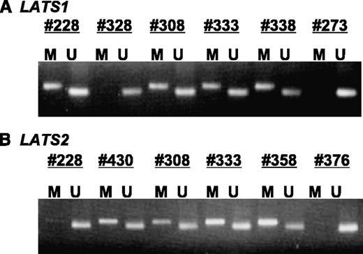 Fig. 2. Representative results of methylation-specific PCR analysis of LATS1 (A) and LATS2 (B) in six breast tumors. M, methylated; U, unmethylated.
