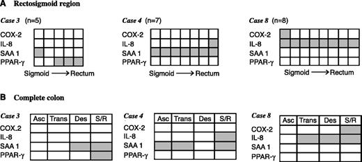 Fig. 2. Distribution of alterations of gene expression in normal colon mucosa of individuals with a family history of colon cancer. A, altered gene expression in rectosigmoid biopsy samples from three individuals (cases 3, 4, and 8). Number of biopsy samples from each individual (n). Biopsy sample (box). B, altered gene expression in ascending (Asc), transverse (Trans), descending (Des), and rectosigmoid (S/R) colon. Indicated colon segments (box). Names of the genes analyzed (left of each row). Presence of altered gene expression in the corresponding samples/colon segments analyzed (shaded box).