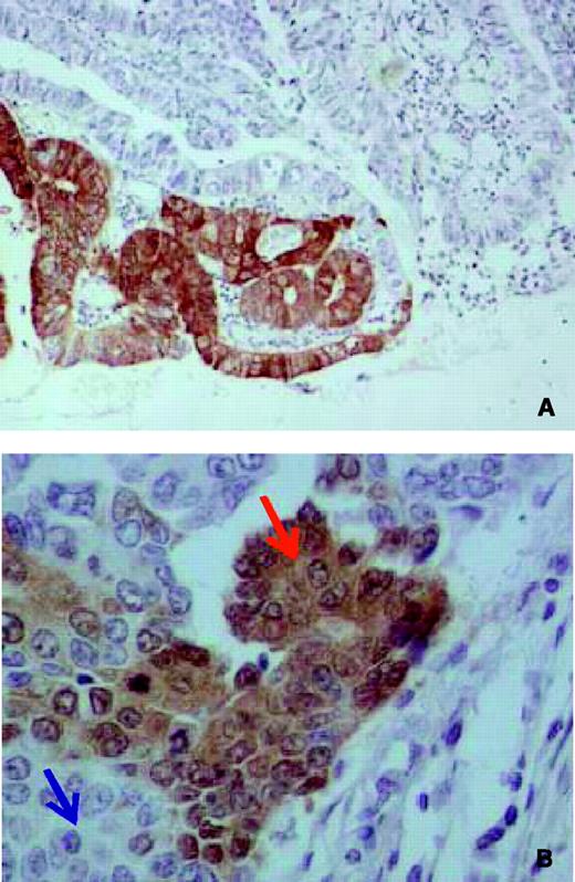 Fig. 4. Immunohistochemical staining of NY-ESO-1 protein in gastric cancer by monoclonal antibody E978. A, ×100 photograph of the stained region; B, ×400 photograph of the stained region, showing heterogeneously expression of NY-ESO-1. Red arrow, positive staining tumor cells; blue arrow, negative staining tumor cells.
