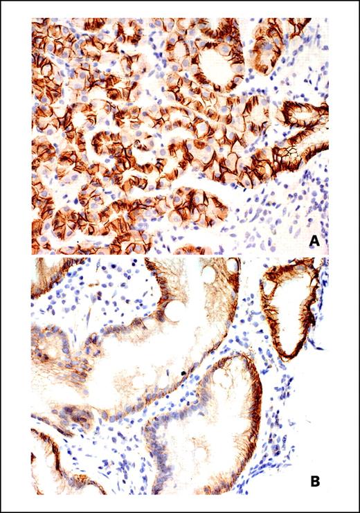 Fig. 4. E-cadherin expression in gastric epithelium. A, membranous expression of E-cadherin in normal gastric epithelium. B, mild reduction in E-cadherin immunoreactivity in foci with intestinal metaplasia. Stain, E-cadherin antibody. (Original magnification, A, ×200, B, ×400).