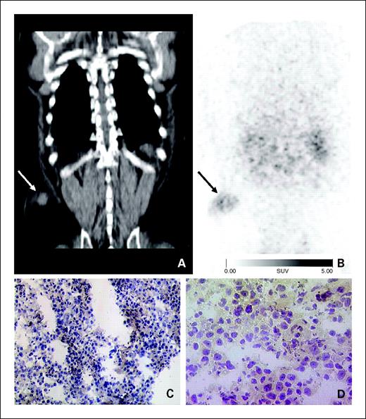 Fig. 3. Male patient (66 years old) with a subcutaneous metastasis from melanoma (arrow). A, tumor in the right laterodorsal abdominal wall. The tumor shows only moderate [18F]Galacto-RGD uptake (B, SUV, 2.2) and only weak staining of the tumor cells in immunohistochemistry (C and D, magnification of tumor cells).