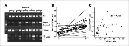 Fig. 1. Expression of endocan mRNA in lung tumors. A, typical PCR from 5 patients. L, normal lung; T, tumor. B, semiquantitative analysis of endocan expression in human tumors; each line is an individual patient. Solid circles with a bold line between them are the median values for each group. C, correlation between endocan and VEGF expression evaluated by semiquantitative PCR in lung tumors. Spearman ρ = 0.568; P = 0.006.