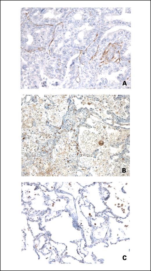 Fig. 2. Immunohistochemical staining for endocan. Lung adenocarcinoma shows a strong anti-endocan staining of endothelial cells in the tumor (A) and peritumoral area (B) compared with a negative staining of normal lung (C). For all images, MEP08 anti-endocan monoclonal antibody staining and hematoxylin counterstaining were done. Magnification, ×200.
