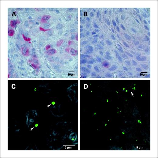 Fig. 2. Immunohistochemical staining for AURKA in HNSCC (A and B). Representative cases for strongly positive staining with predominant cytoplasmatic staining pattern (A) and weakly positive staining (B). Immunostained centrosomes (C and D) detected with an anti–γ-tubulin antibody in HNSCC (C and D). Representative cases with structural and numerical centrosome aberrations. Note the markedly enlarged (C, arrows) and supernumerary centrosomes (D, arrow).