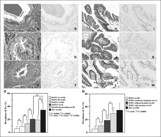 Fig. 3. Increased population of TR in tumor stroma corresponding to the progression of PanINs and IPMNs. A to F, representative features of PanIN-1A (A and B), PanIN-1B (C and D), and intraductal spreading of adenocarcinoma (E and F) in HE staining (A, C, and E) and immunostaining with FOXP3 (B, D, and F). G, prevalence of TR in stroma surrounding pancreatic ducts occupied by intraductal lesions or stroma of invasive ductal adenocarcinoma (IDC). Intraductal spreading: Intraductal spreading of adenocarcinoma without invasion of cancer cells surrounding the duct. H to M, representative features of IPMA (H and I), IPMN with moderate dysplasia (J and K), and IPMC without invasion (L and M) in HE staining (H, J, and L) and immunostaining with FOXP3 (I, K, and M). N, prevalence of TR in stroma surrounding pancreatic ducts occupied by intraductal lesions or stroma of invasive ductal adenocarcinoma. Thin bars, SD.