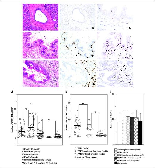 Fig. 4. Infiltration of CD8+ IEL was marked in low-grade premalignant lesions, diminished in borderline lesions, and eventually disappeared in carcinoma in situ. A to G, representative features of normal duct (A and B), PanIN-1B (C, D, and G), and intraductal spreading of adenocarcinoma (E and F) in HE staining (A, C, and E) and immunostaining with CD8 (B, D, and F). The majority of the CD8+ IEL express TIA-1 (G). H and I, representative features of IPMA (H) and IPMC (I) in double immunostaining with FOXP3 (brown) and CD8 (purple). In IPMA (H), there were many CD8+ IEL, stromal infiltrating CD8+ T cells, and few FOXP3+ cells (arrow) around ducts. Although there was no CD8+ IEL, we observed stromal infiltrating CD8+ T cells and several FOXP3+ cells (arrows) around ducts in IPMC without invasion (I). No FOXP3+ IEL was found. J and K, average number of CD8+ IEL in intraductal lesions of PanINs (J) or IPMNs (K). Thick bar and thin bars are average and ±SD, respectively. Intraductal spreading: Intraductal spreading of adenocarcinoma without invasion of cancer cells surrounding the duct. L, prevalence of TR in the draining lymph nodes was not significantly changed among patients with nonneoplastic pancreatic lesions, patients with IPMNs, and patients with invasive ductal adenocarcinoma. Thin bars are ±SD.