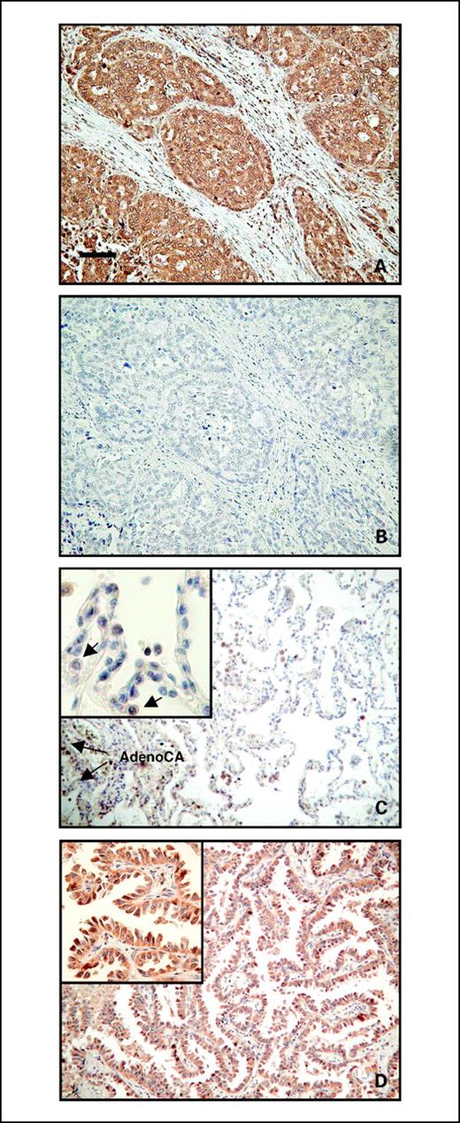 Fig. 4. Immunohistochemical staining of ENO1 in lung tumor tissues. Tissue sections from patients with lung cancer were examined immunohistochemically. Transverse serial sections were obtained from a patient with lung adenocarcinoma (AdenoCA) and stained with ENO1 antiserum (A) or ENO1 antiserum preabsorbed with immobilized GST-fused ENO1 antigen (B) to show specificity of ENO1 antiserum. Normal-like alveolar epithelial cells proximal to the tumor part (arrows) displayed increasing staining of ENO1 in either cytoplasm, nuclear, or membrane (inset, arrows), whereas the distal alveolar walls (C) showed low basal expression. D, inset, adenocarcinoma cells in another patient also showed high level of cytoplasm staining of ENO1. Magnifications, ×100 (A-D) and ×200 (C and D, insets). Bar, 100 μm.