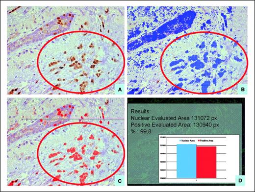 Fig. 1. Computerized image analysis system workflow. Description of the area delimitation (A), masking for nuclei (B), thresholding in the masked area (C), pixel counting and averaging (D).