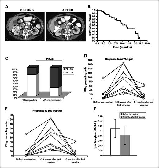 Fig. 4. Association between immunologic and clinical response to vaccination. A, clinical response to vaccine. A patient with progressive disease in retroperitoneal lymph nodes (new, and positive on positron emission tomography scan) 2 months after cisplatin/etoposide therapy was treated with three vaccines at the time of progression. A partial response was observed 6 weeks after the first vaccine administration. Left, an abdominal CT scan done 1 week prior to the first vaccine shows two enlarged retroperitoneal lymph nodes (circled, each 2 cm in diameter). Right, 2 weeks after the third vaccine, the CT scan showed a >60% reduction in the size of both lesions. B, overall survival (in months) of all 29 patients treated with the vaccine from the time of the first vaccine injection. C, 18 patients who progressed after vaccination and subsequently received chemotherapy were divided into two groups according to their immunologic response to the vaccine. PD, progressive disease; SD, stable disease; PR, partial response; CR, complete response (all according to Response Evaluation Criteria in Solid Tumors). P values were calculated using Fisher's exact test. D and E, the results of IFN-γ ELISPOT assay from patients who developed p53 immune response to vaccination. The background level of nonspecific IFN-γ production (ALVAC-control or irrelevant peptide) was subtracted. The number of spots per 1 × 105 cells are shown. All measurements were done in quadruplicate. The mean for each sample is shown. Not all HLA-A2-positive patients were tested both with ALVAC-p53 and p53-derived peptide. F, lymphocyte counts (×109/L) in patients who were treated with second-line chemotherapy. Columns, mean; bars, ± SD.