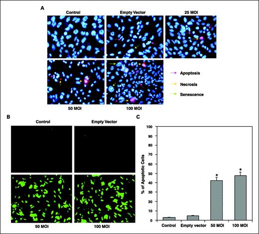 Fig. 2. A, nuclear chromatin staining of U-251 cells with Hoechst 33342 (bis-benzimidazole) and membrane-impermeable propidium iodide. U-251 cells were transfected with rAAV-TFPI-2 at concentrations of 25, 50, and 100 MOI in serum-free medium. An empty vector transfected at a concentration of 100 MOI was used as a vector control. B, fluorescent TUNEL assay of rAAV-TFPI-2–transfected U-251 cells. Cells were transfected with 50 and 100 MOI of rAAV-TFPI-2 in serum-free medium. An empty vector transfected at 100 MOI was used as a vector control. C, quantitative evaluation of TUNEL assay. We used Image-Pro Discovery software to quantify the results of the TUNEL assay. Data are representative of four independent experiments done in duplicate. *, P < 0.001.