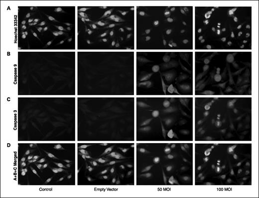 Fig. 5. Double immunofluorescent staining for caspase-9 and caspase-3 expression. U-251 parental cells were cultured on eight-well chamber slides at 2 × 103 per well and transfected with rAAV-TFPI-2 at concentrations of 50 and 100 MOI. An empty vector transfected at a concentration of 100 MOI was used as a vector control. Cells were blocked with 1% bovine serum albumin in PBS and incubated overnight at 4°C with mouse monoclonal caspase-9 and rabbit polyclonal caspase-3 primary antibodies simultaneously. Cells were washed and incubated with Texas red–conjugated anti-mouse and FITC-conjugated anti-rabbit secondary antibodies at room temperature for 1 h. The cells were then washed and treated with 1:100 diluted Hoechst 33342 for nuclear staining. A, Hoechst 33342. B, caspase-9. C, caspase-3. D, A+B+C merged.