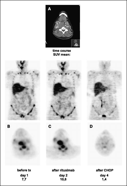 Fig. 4. Conventional CT (A) and FLT-PET scan at baseline (B) of the lymphoma region and coronal whole body image of patient no. 15 (group 2). C and D, corresponding FLT-PET images of the lymphoma region and the coronal whole body image during R-CHOP 2 d after rituximab (C) and 2 d after CHOP (D).