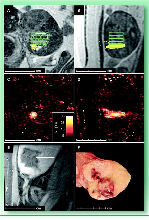Fig. 1. MRgHIFU for ablation of uterine fibroids. MRgHIFU treatment planning of uterine fibroids, monitoring, progression, and posttreatment follow-up. A, coronal T2-weighted MR image was used for treatment planning. Sonication locations and sizes (green lines) were determined with the system planning software and were displayed on top of the treatment plan. During treatment, the accumulated thermal dose (yellow area) was displayed on top of the treatment planning images. B, sagittal T2-weighted MR image shows treatment plan and area that achieved threshold thermal dose. C and D, temperature-sensitive PRF-based MR images were acquired at the peak temperature increase during two sonications. Coronal view (C) was acquired perpendicular to the direction of the ultrasound beam, whereas sagittal view (D) was acquired parallel to the direction of the beam. (C) and (D) were used to estimate the thermal dose (blue line) for each sonication. E and F, images that depict the results of treatment. E, sagittal contrast-enhanced gradient-recalled echo MR image was acquired 2 days after ultrasound surgery. Nonenhancing area (arrow) is seen clearly in (F), which is a gross pathologic cut specimen that shows the central area of hemorrhagic necrosis. Reproduced with permission from the Radiological Society of North America from Tempany CM, Stewart EA, McDonnald N, et al. MR imaging-guided focused ultrasound surgery of uterine leiomyomas: a feasibility study. Radiology 2003;226(3):897–905.