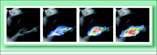 Fig. 2. Temperature evolution during MRgHIFU treatment of a VX2 tumor implanted in the thigh muscle of a rabbit. A, T2-weighted coronal image of the tumor acquired before heating with the tumor showing bright (just below the center of the image). The tumor was heated in two successive periods with the HIFU focal point covering the tumor in a spiral sequence. The temperature map at the end of the first spiral sequence coverage of the tumor (B) and at 50% (C) and 100% (D) of the second spiral sequence, respectively. Color level range: blue, 4°C to 8°C; green, 8°C to 12°C; red, above 12°C temperature rise. From Magnetic Resonance in Medicine, Vol. 49, No. 1, 2003, 89–98. Copyright © 2003, Wiley-Liss. Reprinted with permission of Wiley-Liss, Inc. a subsidiary of John Wiley & Sons, Inc.