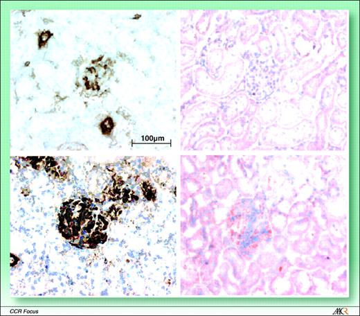 Fig. 3. Expression of luciferase under control of the hsp70B promoter in modified MSCs located in the rat kidney of a rat that was heated by MRgHIFU during 5 min at 45°C. The left kidney of the rats was injected via one of the renal artery branches. Cells (300,000) were injected. Red, luciferase activity was detected on frozen tissue sections with anti-luciferase antibody. Smooth muscle actin staining (brown) was used for MSC detection (but is also positive for vascular smooth muscle cells). Top row, control kidney sections that received MSCs but were not heated. Left, smooth muscle actin–positive MSCs in glomeruli as well as basal smooth muscle actin in recipient vascular smooth muscle cells; right, no detectable luciferase. Bottom row, kidney sections that received MSCs and were heated. Right, luciferase activity; left, smooth muscle actin expression in vascular smooth muscle cells (bottom left).