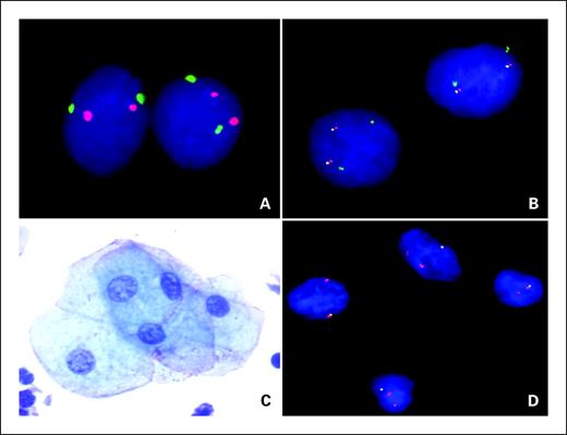 Fig. 1. FISH analyses of exfoliated cells from sputum specimens. A, dual-color FISH analysis of cells from a healthy nonsmoker shows two green signals from the SFTPC probe and two red signals from the CEP8 probe. Original magnification, ×1,000. B, tricolor FISH analysis of cells from healthy nonsmoker shows two green signals from the HYAL2 probe, two yellow signals from the FHIT probe, and two red signals from the CEP3 probe. Original magnification, ×1,000. C, cytologic analysis of sputum sample from a lung cancer patient shows cells with atypical metaplastic changes. Original magnification, ×60. D, tricolor FISH analysis of bronchial epithelium prepared from the same lung cancer patient shows homozygous deletion of HYAL2 (no green signals) and hemizygous deletion of FHIT (one yellow signals). There are two red signals from the CEP3 probe, indicating diploidy of chromosome 3. Original magnification, ×400.