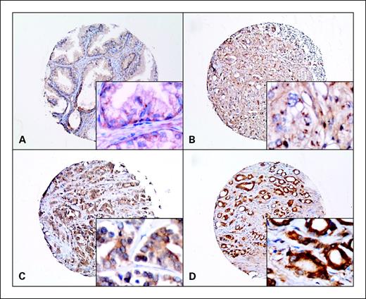Fig. 1. XIAP protein expression in morphologically normal prostate and prostate cancer on tissue microarrays. Immunohistochemical staining for XIAP protein is seen on representative prostate tissue samples. A, normal tissue showing weak cytoplasmic epithelial staining of glandular cells. Staining in basal cells is frequently higher than that seen in glandular cells; scoring is from glandular cells. Invasive prostate cancers are shown demonstrating weak (B), moderate (C), and strong (D) cytoplasmic staining. Magnification, 100×, with 400× inserts.