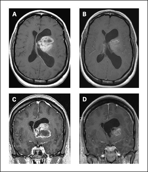 Fig. 1. Baseline and posttreatment MRIs of patient treated with bevacizumab and irinotecan. Postcontrast axial and coronal T1-weighted magnetic resonance scans in a patient with an anaplastic astrocytoma at baseline (A and C) and after four cycles of irinotecan/bevacizumab (B and D).
