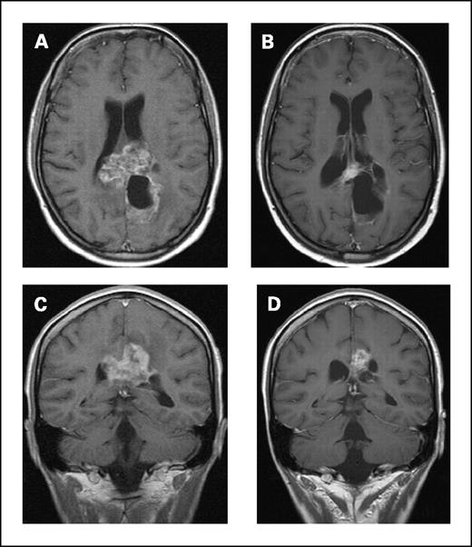 Fig. 2. Baseline and posttreatment MRIs of a second patient treated with bevacizumab and irinotecan. Postcontrast axial and coronal T1-weighted magnetic resonance scans in a patient with glioblastoma multiforme at baseline (A and C) and after four cycles of irinotecan/bevacizumab (B and D).