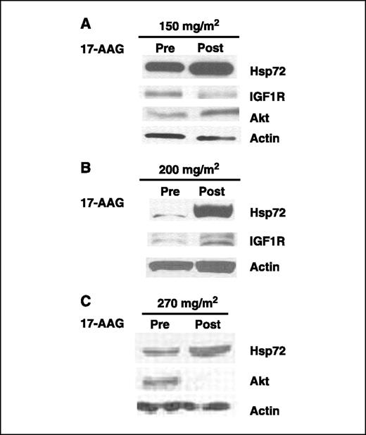 Fig. 2. Immunoblot analysis of protein levels in patient PBMCs. Blood samples were obtained before and 24 h after a single dose of 17-AAG. PBMCs were isolated by gradient centrifugation. Cells were lysed and levels of type I insulin-like growth factor receptor (IGF1R), AKT, and Hsp72 in equal amounts of total protein were evaluated by immunoblotting. Actin levels were assessed as a loading control. Representative blots from individual patients treated at each dose level.