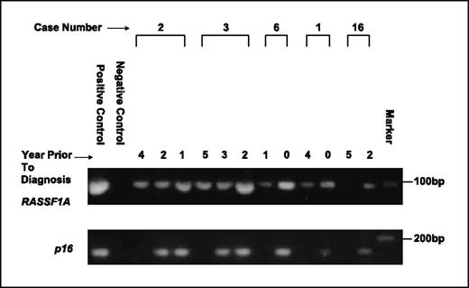 Fig. 1. RASSF1A and p16 methylation status of serum DNA at different time points before diagnosis of HCC. MSP data using methylation-specific primers for RASSF1A and p16 are shown for five cases. PCR products were stained with Vista Green after agarose gel electrophoresis. The size of the PCR products is 93 bp for RASSF1A and 145 bp for p16.