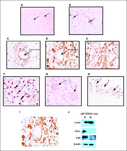 Fig. 7. SOCS3 is highly expressed in primary tumor samples from GBM patients. A and B, SOCS3 protein expression in normal brain tissue was determined by immunohistochemistry. Isolated glial cells stain positive for SOCS3. C and D, primary GBM tumor cells express SOCS3 protein. SOCS3-positive cells cluster around blood vessels. E and F, sections from high-grade, advanced GBM tumors stain extensively for SOCS3. G, high-magnification view of a GBM tissue sample showing high levels of SOCS3 expression in tumor cells. H, section of a GBM tissue sample showing SOCS3-positive tumor cells in a zone of necrosis. I, detail of GBM tissue stained with anti-SOCS3 antibodies shows that SOCS3 protein is expressed almost exclusively in the cytoplasm of tumor cells. J, Western blot analysis of cytoplasmic and nuclear fractions of U87 cells stably expressing c-Myc-tagged SOCS1. SOCS1 protein is present in both the cytoplasmic (C) and nuclear (N) compartments. Blots were stripped and reprobed with anti-β-actin antibody as a loading control.