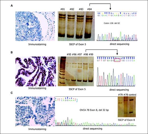 Fig. 1. SSCP, DNA sequencing, and immunohistochemical detection of p53 expression in ovarian cancer. A, the SSCP analysis of exon 5 from case no. 84 (serous ovarian carcinoma) clearly shows the appearance of an additional band (*). The subsequent DNA sequencing confirmed a 2-bp deletion (GC) in codon 138 that results in a premature stop codon. P53 was not detectable by immunohistochemistry in case no. 84. B, SSCP and DNA sequencing of exon 5 from case no. 98 (serous ovarian carcinoma) revealed a missense mutation in codon 175 (CGC to CAC) resulting in an Arg to His substitution. P53 immunostaining showed overexpression of the TP53 protein. C, SSCP, DNA sequencing, and immunohistochemical detection of TP53 expression in case no. 78 (clear cell ovarian carcinoma) which is characterized by a 32-bp deletion in exon 8 of the TP53 gene and the absence of p53 immunostaining.