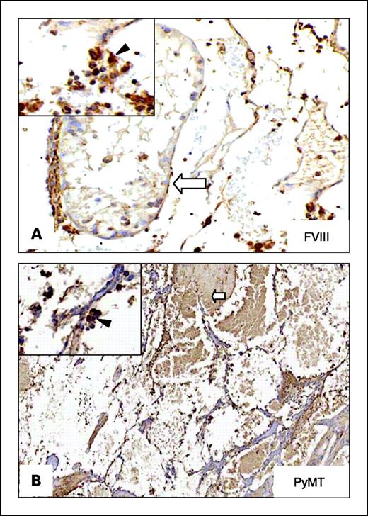 Fig. 4. Factor VIII and PyMT expression in cells lining the cystic cavities of infected SCL-TVA mice. A, staining with antibody to von Willebrand factor. The cells lining the cavities are positive for von Willebrand factor (inset, arrowhead, ×200), showing their endothelial origin. White arrow, a remaining testicular structure (×14). B, staining with anti-PyMT antibody. The neoplastic cells show moderate to strong positive staining (white arrow, ×110). Inset, arrowhead, a group of PyMT-positive cells (×200).