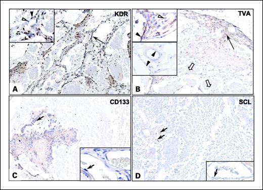 Fig. 5. PyMT-induced lesions contain clusters of TVA-expressing cells. A, staining with antibody to KDR/VEGFR2 in vascular lesions and normal vasculature. KDR is expressed in a high percentage of the endothelial cells; most show strong reactivity (black arrow, ×110; black arrowhead in inset, ×200), with a few isolated cells remaining negative (white arrowhead). B, staining with anti-TVA antibody. White arrows, blood-filled cavities with negative staining. Even at this low magnification (×115), positive staining is readily detected in the proliferating cells in the lesion (black arrow). At higher magnification (top inset, ×200), positive staining for TVA is evident in the endothelial proliferating cells (black arrowhead), whereas a few cells remain unreactive (white arrowhead). Nonneoplastic vessels in the vicinity of the tumor show only weak and focal staining or remain negative (black arrowheads, bottom inset). C, CD133 staining. Arrow, a group of strongly positive transformed endothelial cells in the hemangiomatous lesion (×110). Inset, a normal vessel where endothelial cells are negative for CD133. Arrow, nucleus of a normal endothelial cell (×200). D, staining with anti-SCL antibody. Arrows, positive cells within the proliferating endothelium in vascular lesion (×110). Inset, a normal venous structure that is close to the lesion. The normal endothelium (arrow) remains negative (×200).