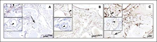 Fig. 6. PyMT-infected endothelial cells in tumor areas of SCL-TVA mice have elevated levels of phospho-Akt and phospho-S6. A, staining with anti-pAkt Thr308 antibodies in vascular lesions and normal vasculature. Arrow, cells that are positive for pAkt Thr308 (×110). Top inset, arrowhead, pAkt Thr308-positive cells (×200); bottom inset, normal endothelium showing low immunoreactivity for pAkt Thr308. B, staining with anti- pAkt Ser473 antibodies in lesions. Top inset, arrowhead, strong pAkt Ser473 staining in vessel structures; bottom inset, arrowhead, mild staining in normal endothelial cells of unaffected vasculature. C, tissues from affected and normal areas were stained with anti-phospho-S6 antibodies. Arrow, proliferating cells with strong immunoreactivity for pS6 (×110). Top inset, arrowhead, pS6-positive cells in vascular structure (×200); bottom inset, normal endothelium showing low pS6 immunoreactivity.