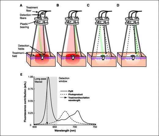 Fig. 1. Treatment and measurement cycles during system operation include (A) PDT delivery at 632.8 nm with fluorescence monitoring in the lesion, (B) PDT delivery with fluorescence monitoring in the perilesion margin, (C) broadband interrogation with reflectance monitoring in the lesion, and (D) broadband interrogation with reflectance monitoring in the margin. E, normalized fluorescence emission curves for PpIX and photoproduct I illustrating the relative location of the 632.8 nm treatment beam to PpIX and photoproduct I fluorescence and the detection window in which fluorescence was monitored with this instrument.