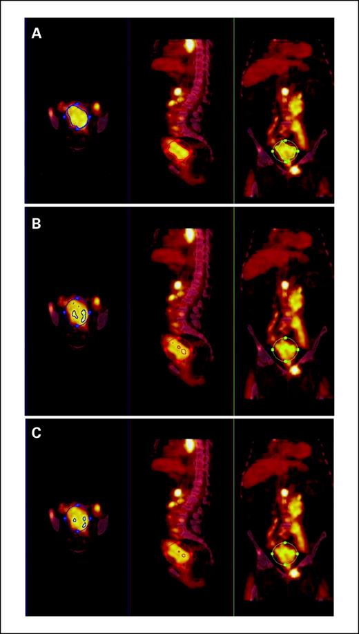 Fig. 2. A region of interest is drawn around the primary cervix tumor and the surrounding normal tissue. A, the 40% threshold represents the “actual” tumor volume. Decreasing volumes are represented by the 60% threshold (B) and the 80% threshold (C). From left to right, images are shown in axial, sagittal, and coronal planes.