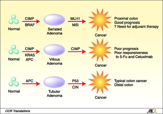 Fig. 1. Multiple parallel pathways to colorectal cancer, with clinical implications for therapy. Instead of a linear, single progression model, sporadic colorectal cancer seems to arise from (at least) three distinct parallel modes. The top and bottom pathways are the most homogeneous, with clear distinctions in precursor lesions (serrated vs. tubular adenomas), genetics (BRAF vs. APC and p53 mutations, MSI vs. CIN), epigenetics (CIMP positive vs. negative) and outcome (good vs. average). The middle pathway is more heterogeneous than depicted (or perhaps incompletely understood). It may arise mostly from villous adenomas, but perhaps also from serrated adenomas. It has a different form of CIMP, predominant KRAS but occasional BRAF mutations, usually lacks CIN, and has the worse prognosis, with apparently lower responsiveness to chemotherapy. The prevalence of the three pathways is estimated at 10% to 20% (top pathway), 10% to 30% (middle pathway), and 50% to 70% (bottom pathway).