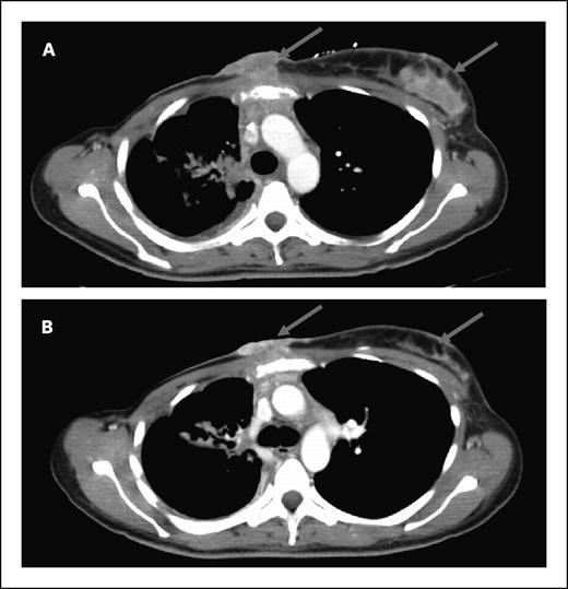Fig. 1. Computed tomography of a patient with Her2-negative p53-mutant metastatic breast cancer before (A) and after two cycles (B) of 17AAG and irinotecan given at the MTD, showing regression of chest wall metastases (arrows).