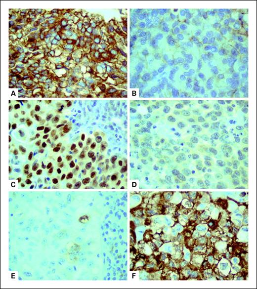 Fig. 1. Differential expression in primary-metastatic pairs. Loss of E-cadherin and TTF-1 expression was seen in these metastatic tumors (B and D, respectively), compared with their corresponding primary tumors (A and C, respectively). In contrast, acquisition of p-S6 was observed for another metastatic tumor (F), compared with its corresponding primary tumor (E).