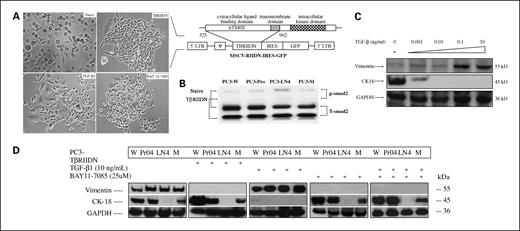 Fig. 1. NF-κB-mediated TGF-β-induced up-regulation of vimentin and down-regulation of CK18 in prostate cancer. A, left, overall morphology of prostate cancer cells (with PC-3 as sample, the cells were plated for 72 h; the confluent percentage is 20% at the beginning) shape changed and showed an extended and elongated shape, and cell-cell contact decreased after treatment with TGF-β. Meanwhile, after down-regulating TGF-β signal by infection with a TβRIIDN or treatment by BAY11-7085, all cells, irrespective of their aggressive potential, recovered cell-cell contact (magnification, 10 × 10). Right, construct of TβRIIDN retrovirus vector. B, Western blot showed that, after infection of TβRIIDN, the activity of p-Smad2 of all PC-3, PC-3M-Pr04, PC-3M-LN4, and PC-3M was down-regulated significantly. C, there is a dose-dependent relationship between treatment of TGF-β and expression of vimentin (positive) and CK18 (reverse) in all PC-3 cell lines (with PC-3 as sample, the amount of protein loaded is 8.0 μg). D, high level of vimentin expression and much lower CK18 expression levels are found in PC-3M and PC-3M-LN4, respectively, which have more aggressive potential compared with PC-3. After blocking TGF-β by infection with a TβRIIDN, vimentin expression was down-regulated in each group and CK18 was up-regulated correspondingly, except for PC-3M-LN4. Interestingly, on treatment with NF-κB inhibitor, the effect of TGF-β on EMT was reversed. The detailed graph could be found in Supplementary Fig. S2. This result showed that NF-κB is the major mediator downstream for TGF-β-induced EMT in prostate cancer cell lines (to distinguish the expression between each PC-3 variants, we loaded 20 μg protein for each sample).