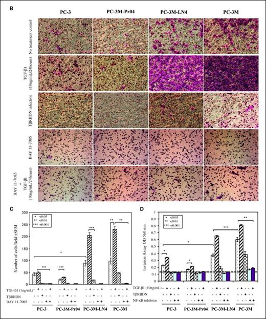 Fig. 3. NF-κB-mediated TGF-β1-induced EMT is the cause of invasion of prostate cancer. A, colocalization of TGF-β signal and NF-κB and vimentin were analyzed in all cell lines by using immunofluorescein staining (with PC-3 as sample). Only the cells expressing NF-κB exhibited vimentin expression. In control, after cells were infected with TβRIIDN, both vimentin and NF-κB were inhibited dramatically (magnification, 10 × 20). B, PC-3M-LN4 and PC-3M possessed significantly higher invasive capabilities when compared with PC-3 and PC-3M-Pr04. There was a significant increase in cell motility through a Matrigel-coated polycarbonate membrane under the treatment of TGF-β1 (10 ng/mL). The invasion of all PC-3 cells could be inhibited by blocking the TGF-β signal by infection with a TβRIIDN or using a NF-κB inhibitor separately. The inhibition of invasion by NF-κB is reverted by TGF-β treatment. C, corresponding numbers of invasive cells. D, absorbance values. This result indicates NF-κB-mediated TGF-β-induced EMT potentiates the invasive ability of prostate cancer cell lines.