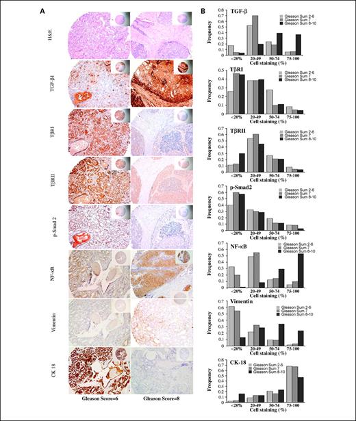 Fig. 4. NF-κB-mediated TGF-β1-induced EMT is determined by tissue microarrays and immunohistochemistry. A, in serial tissue microarray sections from a patient with Gleason score of 8, staining revealed higher expression of TGF-β, NF-κB, and vimentin but lower expression of TGF-β receptors and p-Smad2 compared with serial sections taken from a patient with a lower Gleason grade of 6. Representative of the predominant staining pattern seen in all patient samples/tissue arrays (magnification, 10 × 20). B, corresponding frequency (or percentage) of staining and intensity of staining. High levels of TGF-β1 expression (75-100% cell staining) were identified in 36.7%, 6.7%, and 6.0% of high-grade, intermediate-grade, and low-grade prostate cancers, respectively. The expression of NF-κB was 60.6%, 10%, and 5.2% and vimentin expression was 23.9%, 3.6%, and 1.8% in high-grade, intermediate-grade, and low-grade prostate cancers, respectively. CK18 was 47.1%, 67.2%, and 68% in high-grade, intermediate-grade, and low-grade prostate cancers, respectively.