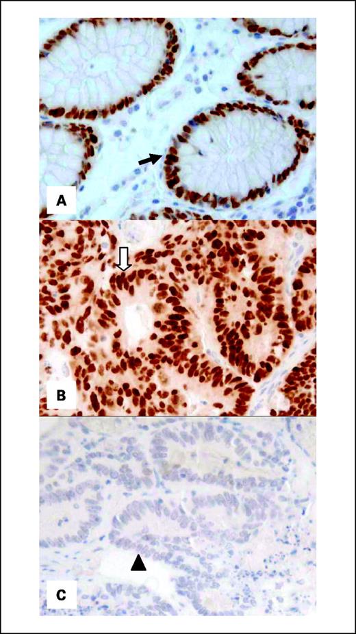 Fig. 1. CDX2 expression in normal colonic mucosa and colon cancer. A, nuclear CDX2 expression in normal colonic epithelial cells (arrow). B, nuclear CDX2 expression in colon cancer cells (white arrow). C, loss of CDX2 expression in colon cancer cells (arrowhead).