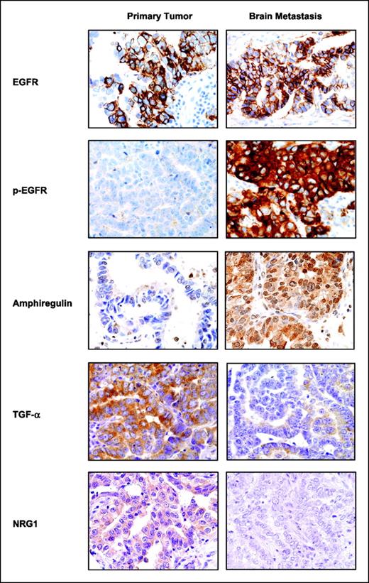 Fig. 1. Representative microphotographs of immunohistochemical expression of EGFR and p-EGFR and the ligands amphiregulin, TGF-α, and NRG1 in primary tumors and corresponding brain metastases. Magnification, ×400. All markers showed protein expression (brown staining) in tumor cells from primary and/or metastasis sites at the membrane and cytoplasm levels. Amphiregulin showed also nuclear expression in malignant cells.