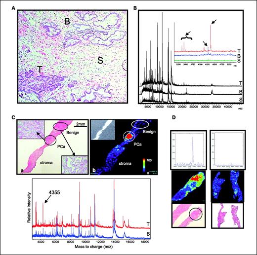 Fig. 1. Direct tissue mass spectrometric analysis of human prostate tissue reveals cell-specific profiles. Frozen prostate tissue was subjected to MALDI-IMS as described. A, representative histologic image of H&E-stained prostate tissue showing areas of prostate adenocarcinoma (T), benign prostate glands (B), and benign stroma (S). B, resulting average spectra acquired from each region showing characteristic profiles for different cell types. Inset, expanded view of the mass range m/z 3,000 to 5,300 showing differences in the profiles for each cell type. C, MALDI-IMS of a single prostate tissue containing tumor and uninvolved regions. a, H&E image of a tissue specimen containing a defined area of PCa glands and benign glands. Insets, magnified (×10) views of each cell type. b, resulting two-dimensional ion density map showing high expression of a peak at m/z 4,355 (red) in the PCa area (inset is a scan of the tissue after matrix deposition). c, average spectra from a single spot obtained in the PCa (T) region and from the benign adjacent glandular (B) area displaying differential expression of the ion at m/z 4,355. D, MALDI-IMS two-dimensional ion density maps of a PCa-containing tissue and a benign prostate tissue. Circled, pathology-defined regions of PCa. Areas in red from the resulting MALDI-IMS indicate high expression of m/z 4,355. Top, spectra exported from representative regions of each tissue are shown in the m/z range of 4,000 to 4,600 and display the m/z 4,355 peak profile.