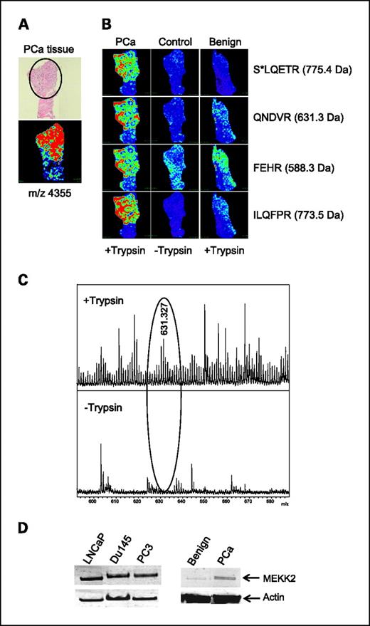 Fig. 4. On-tissue trypsin digestion of PCa region detects predicted peptides of MEKK2 fragment. A, H&E-stained image of PCa tissue with a region of adenocarcinoma circled (top) and MALDI-IMS showing spatial distribution of parent ion at m/z 4,355 (bottom). B, after trypsin treatment of the same tissue, four predicted fragments corresponding to the MEKK2 fragment sequence (SLQETRKAKSSSPKKQNDVRVKFEHRGEKRILQFPR fragments detected are in bold) were detected in the PCa tissue. Control is a serial section of PCa tissue without trypsin treatment. A benign section of prostate tissue was also trypsin treated. C, representative spectra from trypsinized (top) and nontrypsinized (bottom) PCa tissue showing the presence of an ion at m/z 631.3 in the trypsin-treated tissue only. D, Western blot analysis for expression of MEKK2 in the indicated PCa cell lines and tissue lysates. Western blot of PCa cell lines (30 μg) and tissue lysates (100 μg) was done using an antibody to the NH2-terminal region of MEKK2. Actin was used as a loading control.