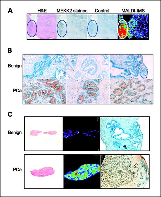 Fig. 5. MEKK2 expression in prostate tissue. A, immunohistochemical analysis of frozen prostate tissue sections. H&E-stained prostate tissue with a region of PCa circled (left), MEKK2-stained serial section showing staining in PCa regions (middle left), and control section without primary antibody (middle right). MALDI-IMS two-dimensional ion density map for m/z 4,355 indicating high expression in the region of PCa, which stained for MEKK2. B, representative areas of MEKK2 staining from three benign (magnification, ×100) and three PCa tissues (magnification, ×200) showing strong expression of MEKK2 in adenocarcinoma cells and little expression in benign glands. C, MEKK2 immunostaining corresponding to m/z 4,355 MALDI-IMS expression in two tissue samples. H&E-stained serial sections (left) are shown for benign (top) and PCa tissue (bottom) with the corresponding MALDI-IMS two-dimensional ion density maps indicating m/z 4,355 expression (middle). Right, MEKK2 immunostaining. Magnification, ×50.