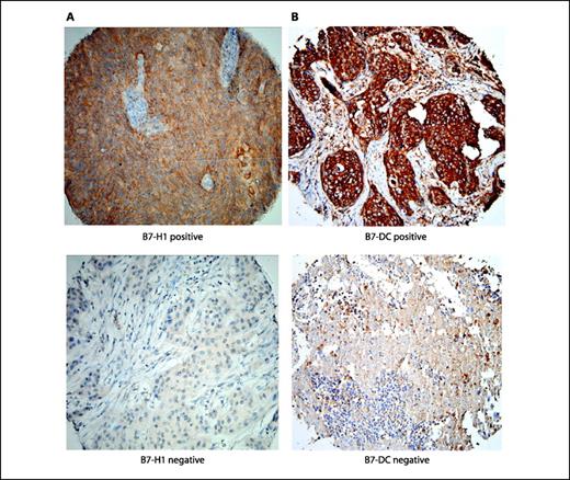 Fig. 1. Immunohistochemical staining of human cervical cancer tissues using B7-H1 and B7-DC antibodies. Expression was defined based on the presence or absence of membranous staining. Specimens with tumor cell surface B7-H1 expression (A, top) and tumor with no B7-H1 staining (A, bottom), and tumor cell surface B7-DC expression (B, top) and tumor with no membranous B7-DC staining (B, bottom).
