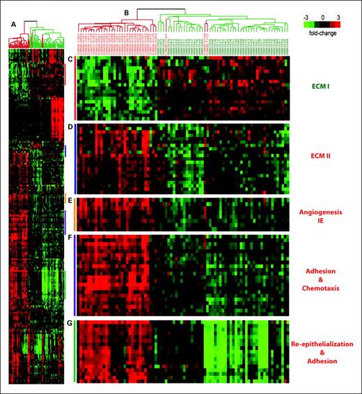 Fig. 1. Wound response signatures are differentially expressed between reduction mammoplasty patients (RM) and histologically normal tissue of cancer patients (cancer normal; CN). A, shows the complete dendrogram for 200 probes that distinguish reduction mammoplasty from cancer-adjacent normal tissues with 98 accuracy in predictive analyses. The dendrogram in B shows cancer-adjacent normal samples (red) and reduction mammoplasty samples (green) form distinct branches, with only a few cancer-adjacent normal tissues clustering with reduction mammoplasty samples. The clusters show that various biological processes involved in wound repair are differentially expressed between the two groups, including ECM alterations (C and D), immediate early (IE) genes involved in angiogenesis (E), re-epithelialization and cellular adhesion (F), and cellular adhesion and chemotaxis (G). Supplementary Table S1 lists log2 (red/green) values for each sample by probe ID, and Supplementary Table S2 provides DAVID analysis results for the 200-probe gene set.